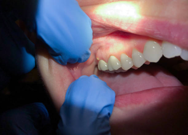 Best Emergency Dental Extractions in Rockwell Place, TX